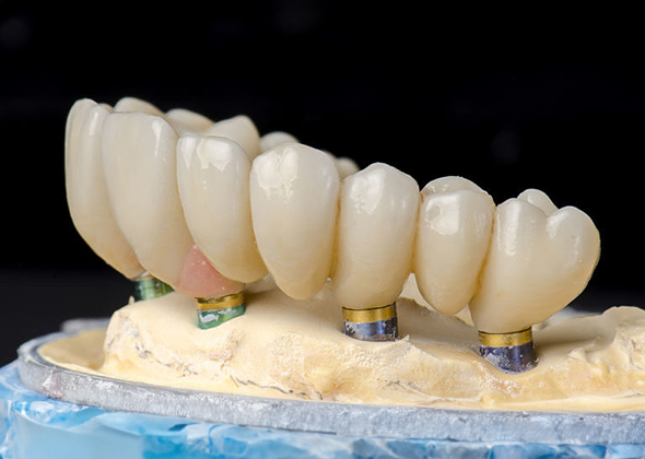 implant-1