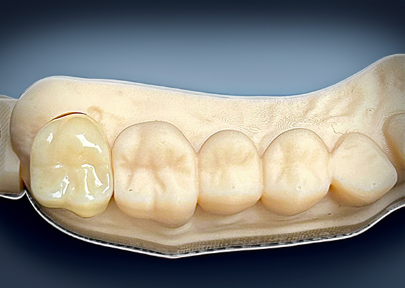 zirconia-3